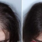 5-antes-e-depois-de-cabroxiterapia-para-alopecia-feminina